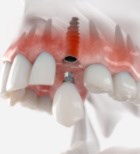 התחליף המלאכותי לשורש: כל מה שחשוב לדעת על השתלות שיניים-תמונה